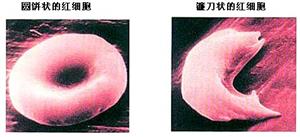 镰刀型细胞贫血症1