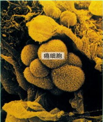 癌细胞